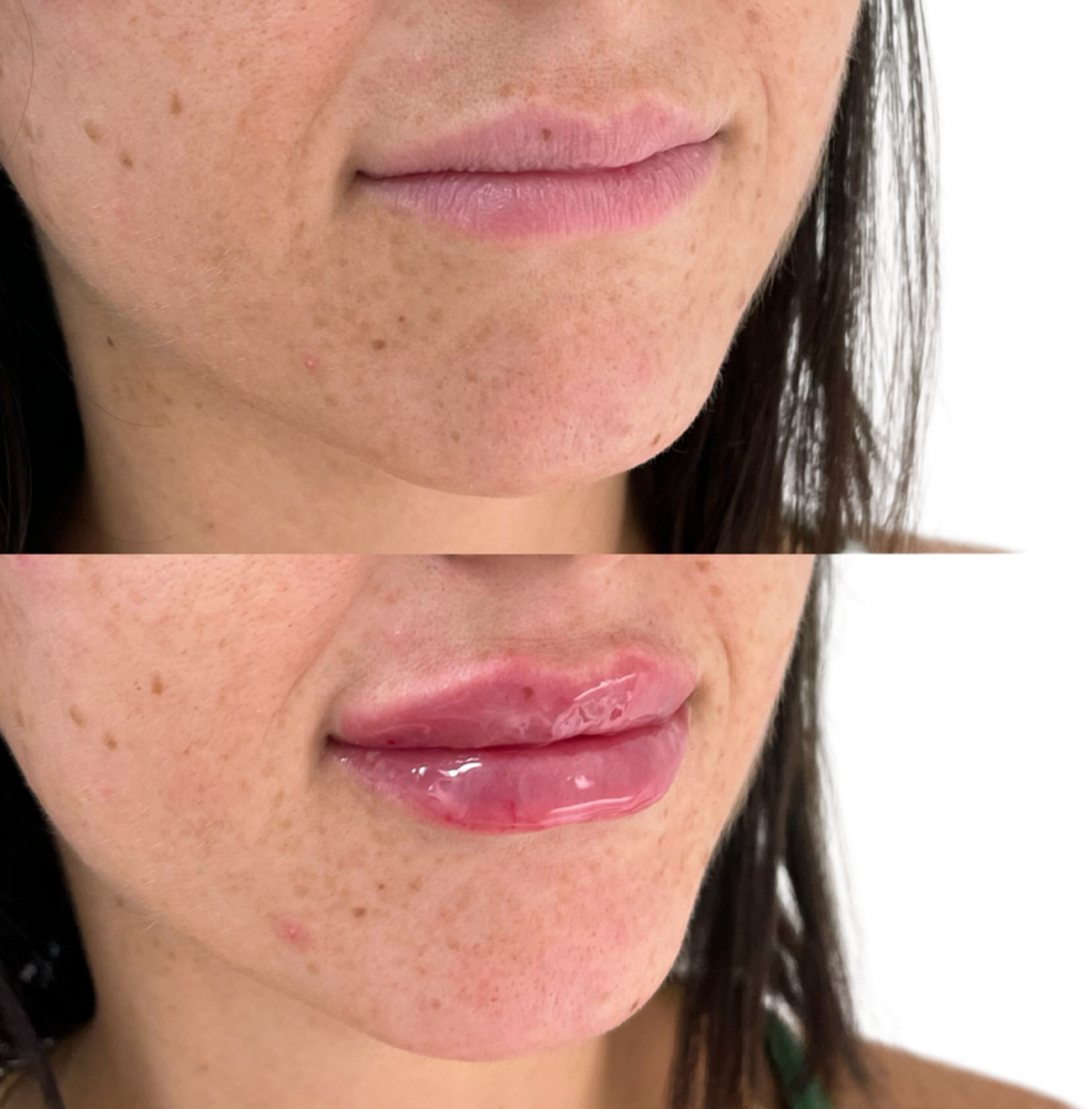 Restylane Before & After