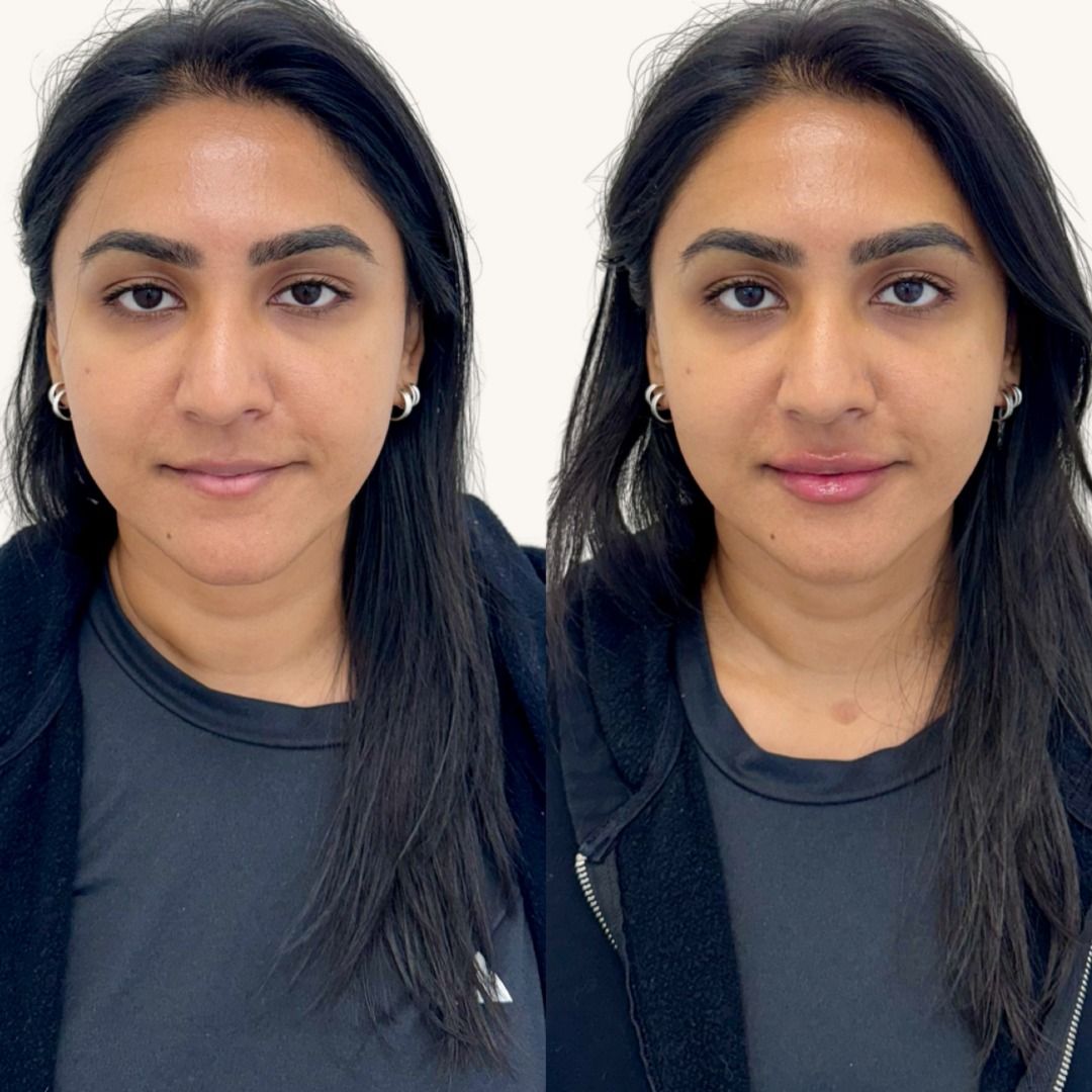 Restylane Before & After