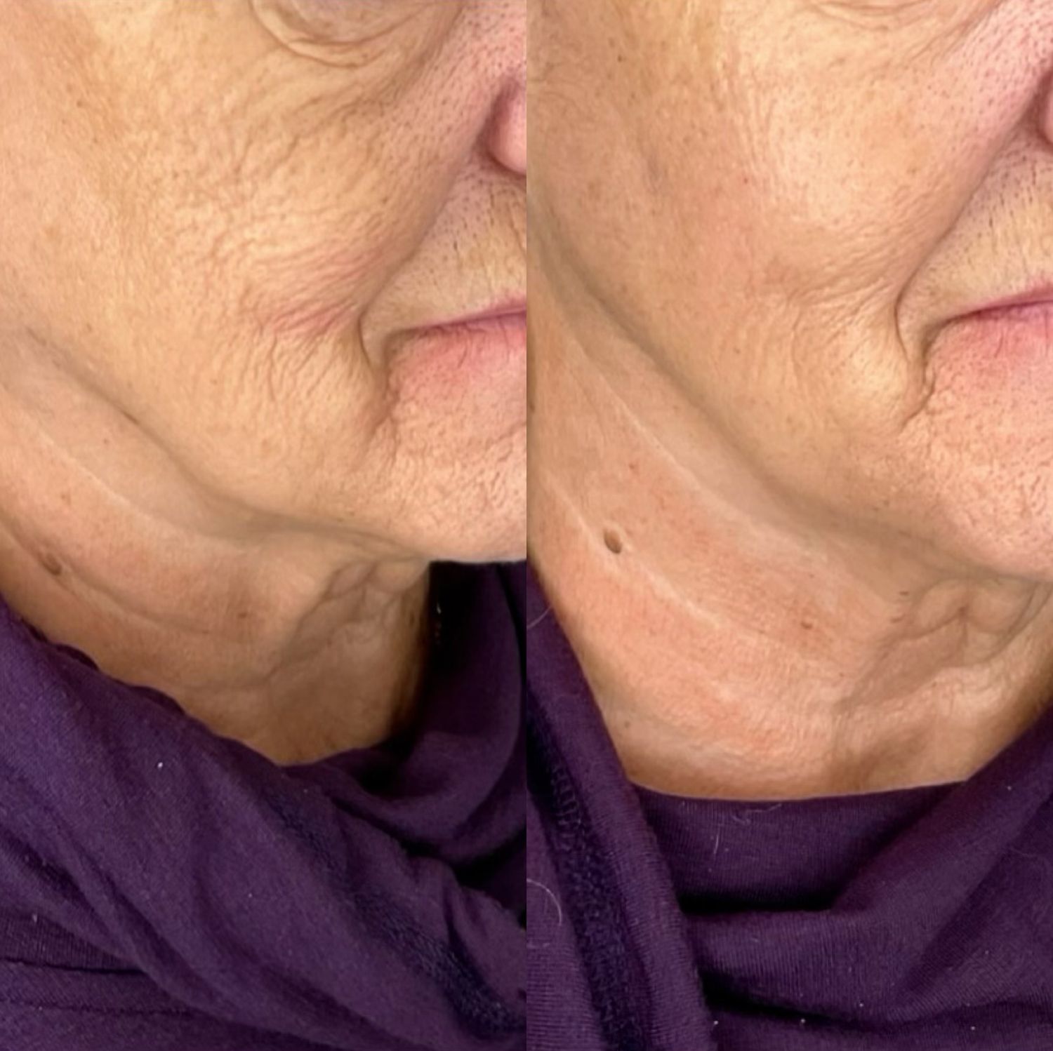 Sculptra Before & After