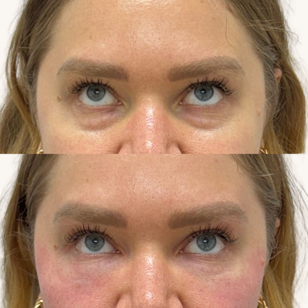 Platelet-Rich Plasma Before & After